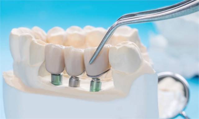 Dental Implants Thornton | Dentist in Thornton CO | Local Dentist 80241 | Timber Dental Care