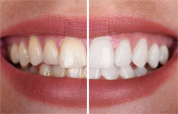 Teeth Whitening Crowley TX — Zoom Whitening Crowley