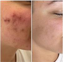 NKD Beauty by Vanessa|Facials |Microneedling Miami NKD  Beauty